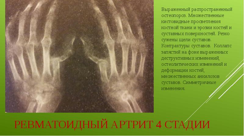 Ревматоидный артрит 4 стадии Выраженный распространенный остеопороз. Множественные кистовидные просветления костной