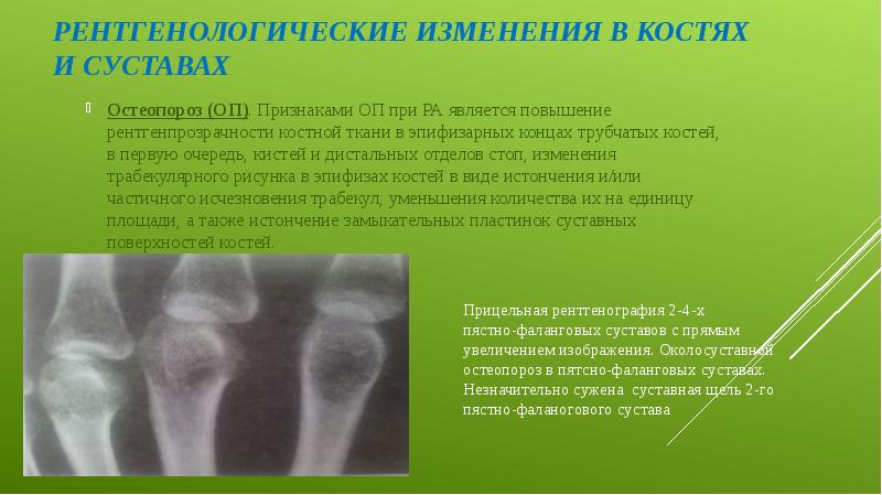Рентгенологические изменения в костях и суставах Остеопороз (ОП). Признаками ОП при