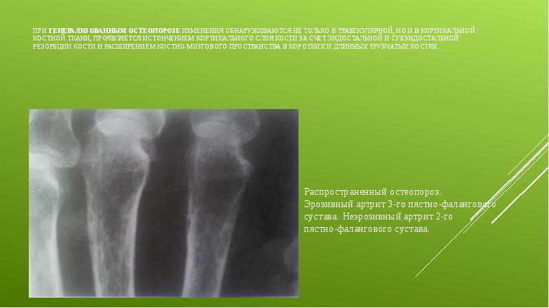При генерализованным остеопорозе изменения обнаруживаются не только в трабекулярной, но и
