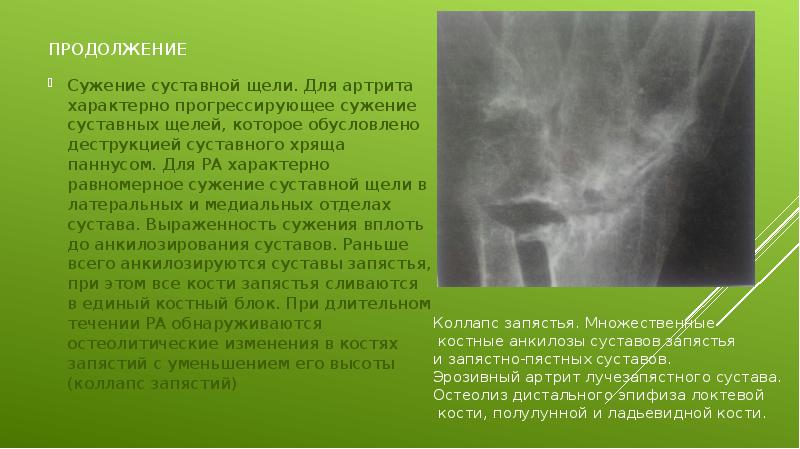 продолжение Сужение суставной щели. Для артрита характерно прогрессирующее сужение суставных щелей,