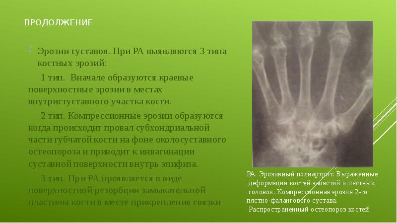 продолжение  Эрозии суставов. При РА выявляются 3 типа костных эрозий: