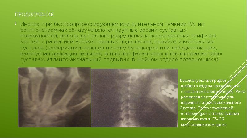 продолжение Иногда, при быстропргрессирующем или длительном течении РА, на рентгенограммах обнаруживаются
