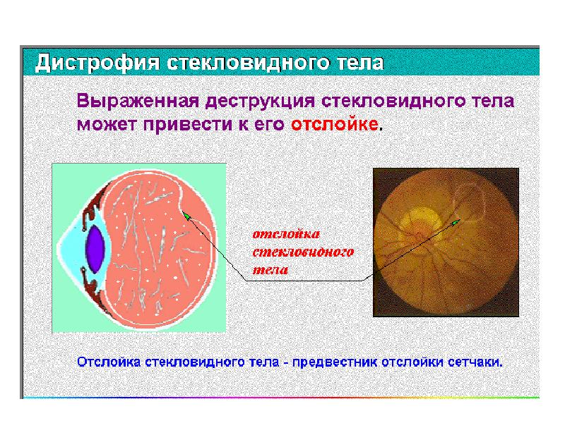 Презентация аномалии рефракции