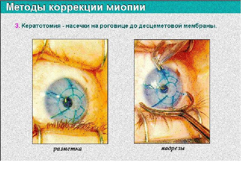 Рефракция офтальмология презентация