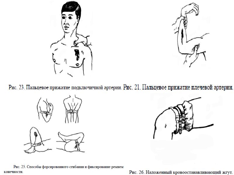 Пальцевое прижатие при повреждении бедренной артерии. Точка пальцевого прижатия плечевой артерии. Пальцевое прижатие плесевойартерии. Пальцевое придатие лучевой артерии. Пальцевое прижатии плевовой артирии.