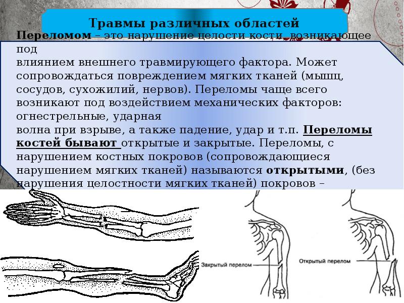 Повреждение целостности тканей. Закрытый перелом картинка. Травмы различных областей. Перелом сопровождается. Переломы могут сопровождаться....