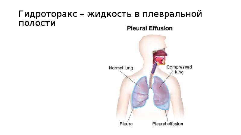 Плевральная жидкость. Гидроторакс границы легких. Осложнения гидроторакса.