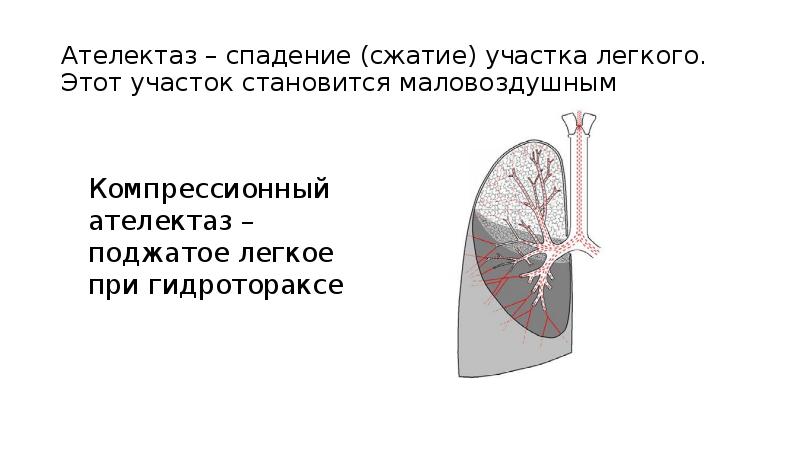 Ателектаз легкого презентация