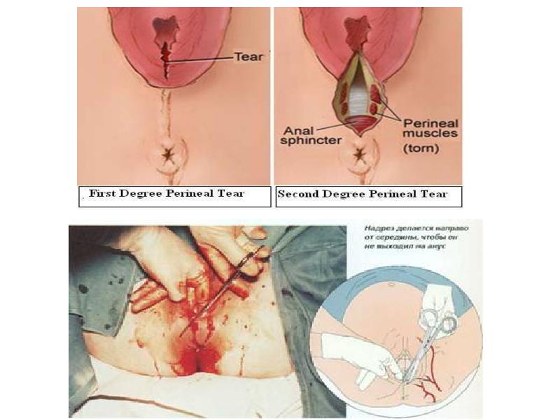 Разрывы при родах: причины, последствия, профилактика