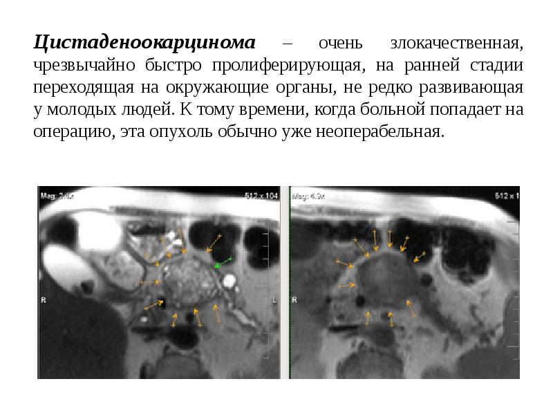 Клиническая картина рака 4 стадии