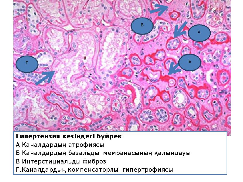 Созылмалы гломерулонефрит презентация