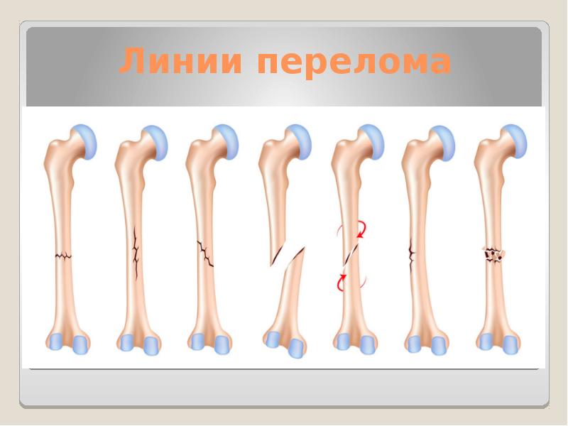 Все виды переломов презентация