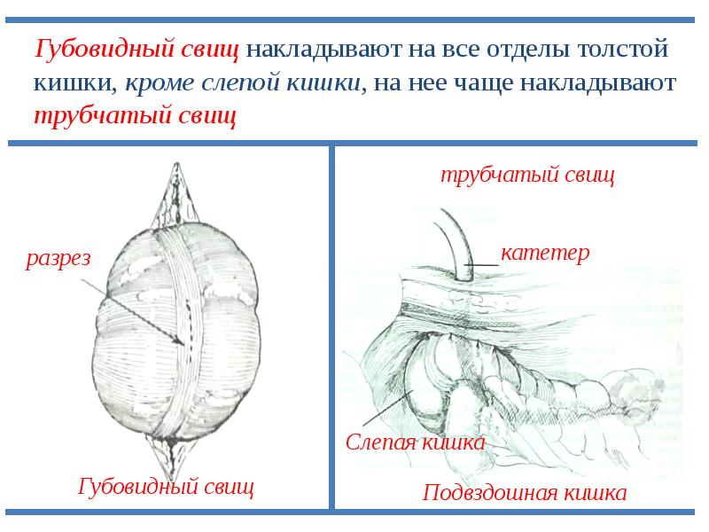 Губовидные и трубчатые свищи желудка