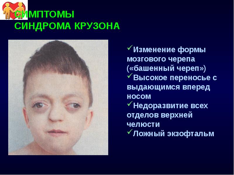 СИМПТОМЫ СИНДРОМА КРУЗОНА Изменение формы мозгового черепа («башенный череп») Высокое переносье