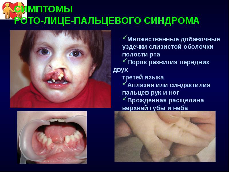 СИМПТОМЫ РОТО-ЛИЦЕ-ПАЛЬЦЕВОГО СИНДРОМА Множественные добавочные уздечки слизистой оболочки  полости рта
