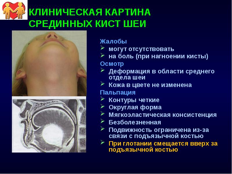 КЛИНИЧЕСКАЯ КАРТИНА СРЕДИННЫХ КИСТ ШЕИ Жалобы могут отсутствовать на боль (при