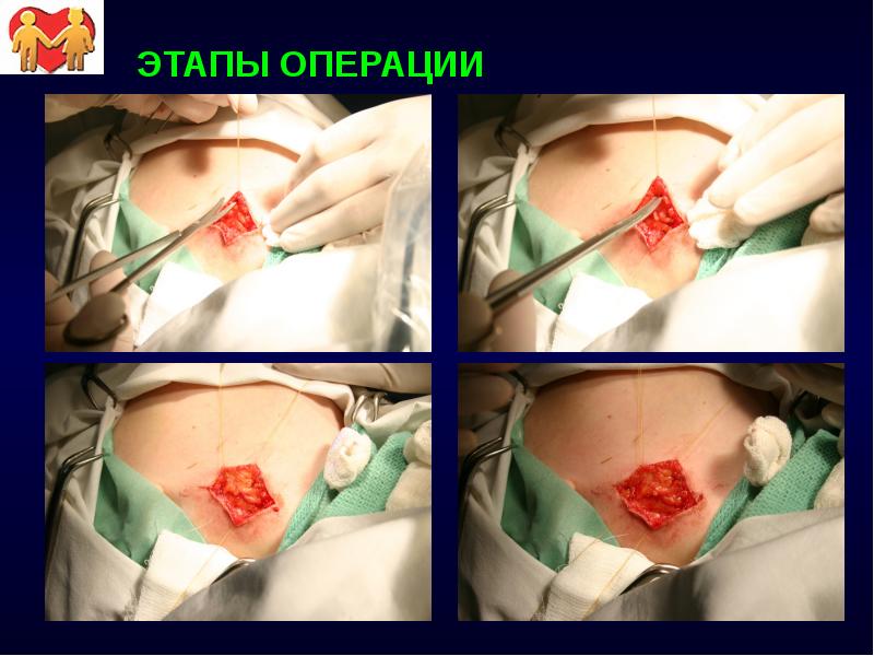 ЭТАПЫ ОПЕРАЦИИ