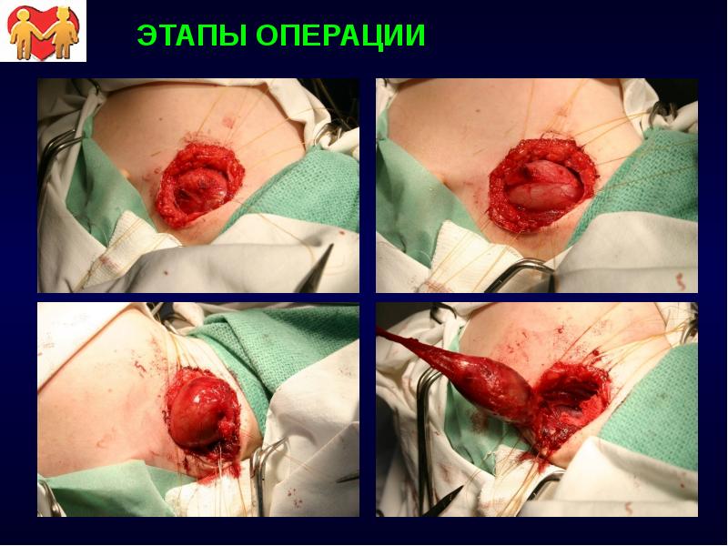 ЭТАПЫ ОПЕРАЦИИ