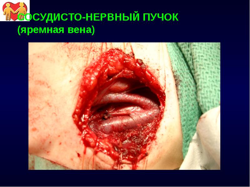 СОСУДИСТО-НЕРВНЫЙ ПУЧОК (яремная вена)