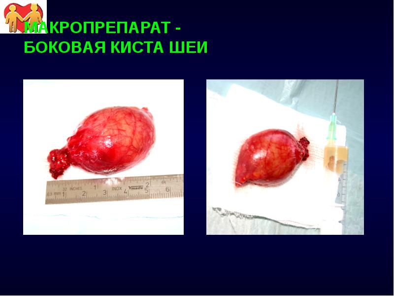 МАКРОПРЕПАРАТ - БОКОВАЯ КИСТА ШЕИ