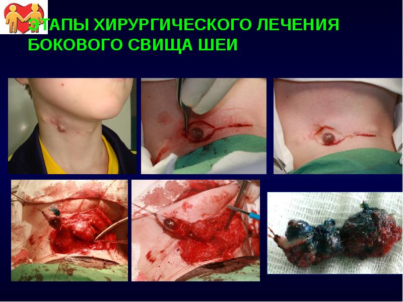 ЭТАПЫ ХИРУРГИЧЕСКОГО ЛЕЧЕНИЯ БОКОВОГО СВИЩА ШЕИ