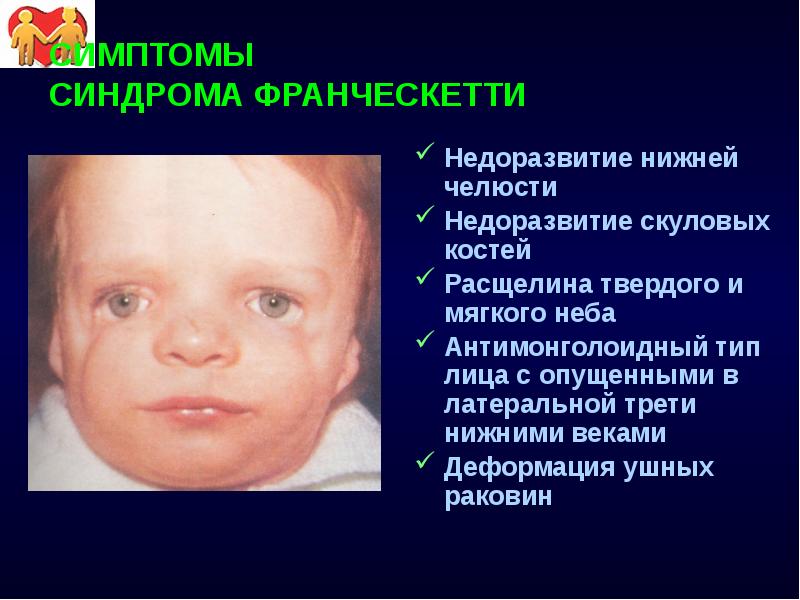 СИМПТОМЫ СИНДРОМА ФРАНЧЕСКЕТТИ Недоразвитие нижней челюсти Недоразвитие скуловых костей Расщелина твердого