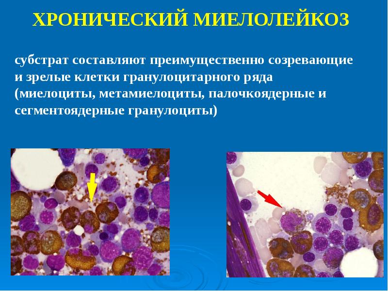 Созылмалы лимфолейкоз презентация