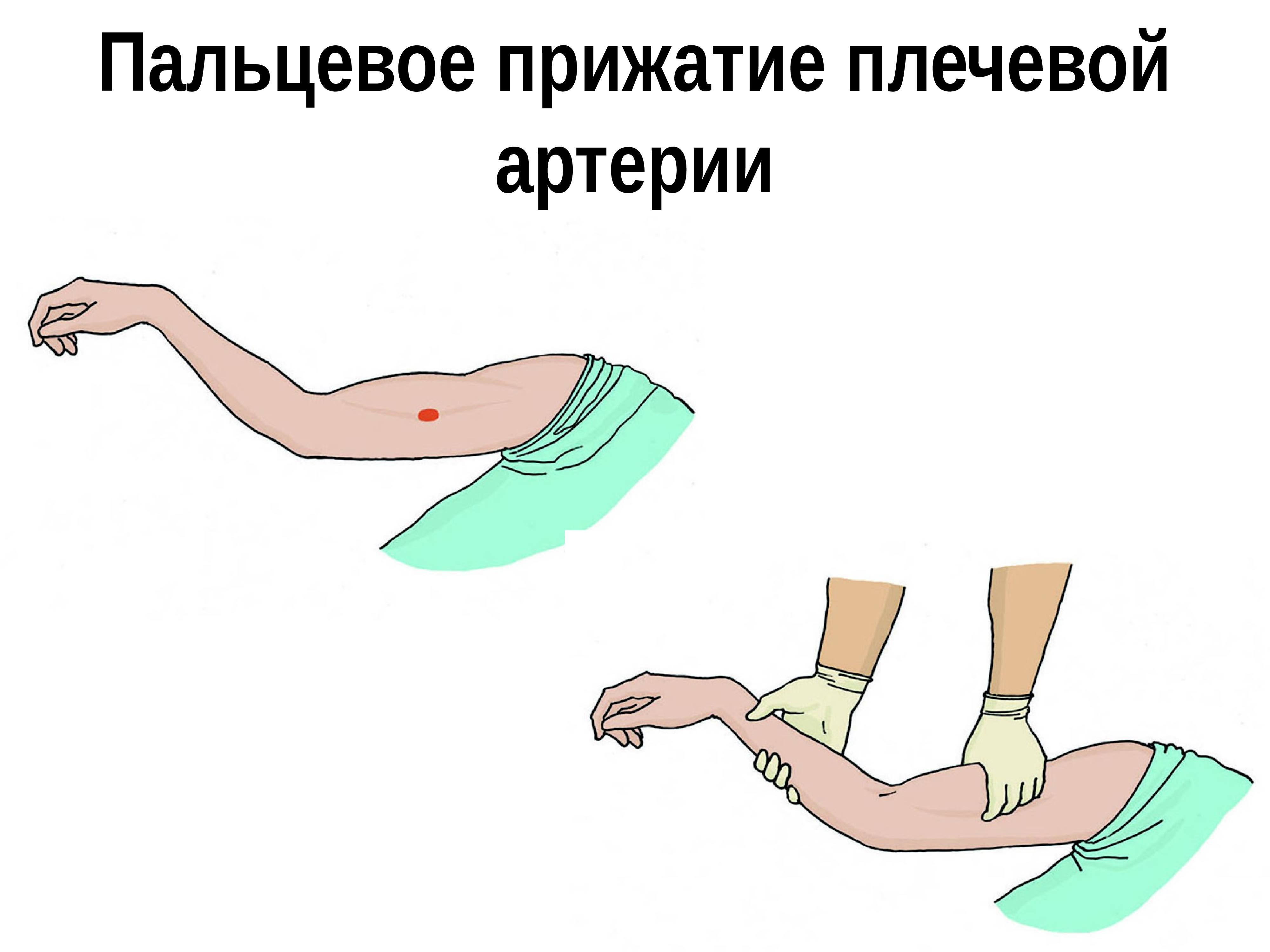 Первая помощь при наружном кровотечении