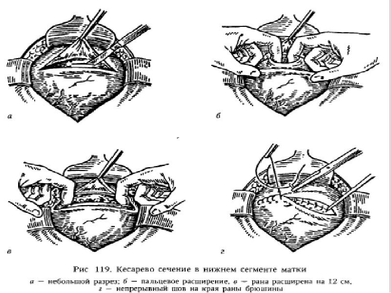 Кесарево сечение рисунок