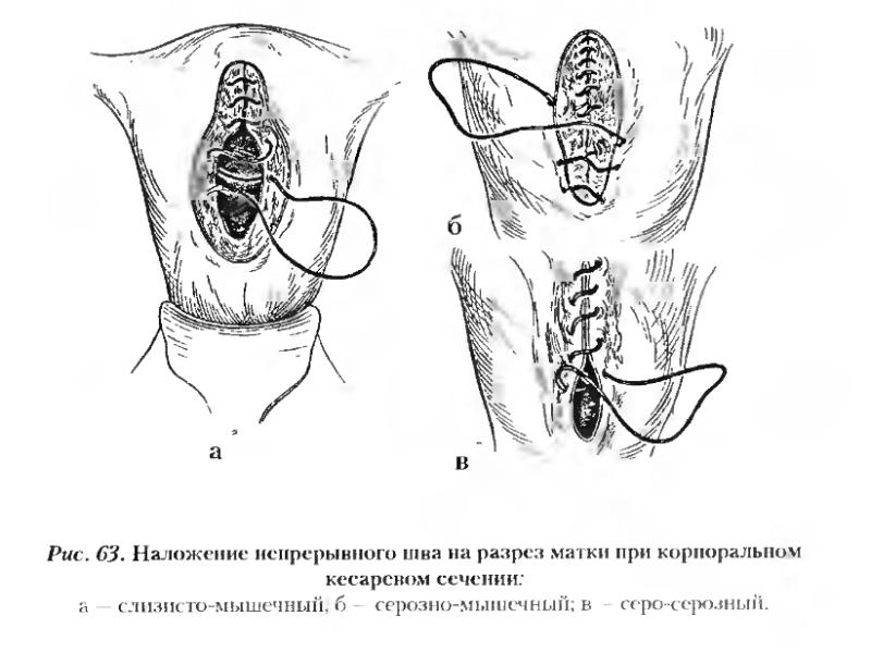 Истмико корпоральный разрез на матке рисунок