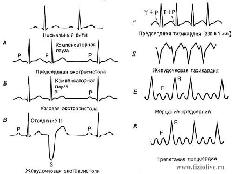 Частые желудочковые экстрасистолы карта вызова