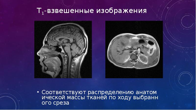 Взвешенных по т1 и т2. Т1 и т2 взвешенные изображения в мрт. Т2 взвешенное изображение мрт. Т1 взвешенное изображение. Т1 мрт изображение.