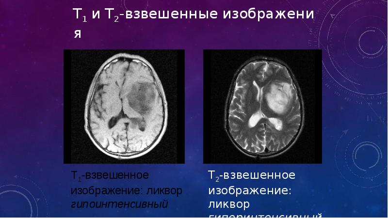 Т1 и т2 взвешенные изображения в мрт