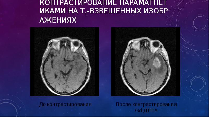 Т1 взвешенное изображение мрт