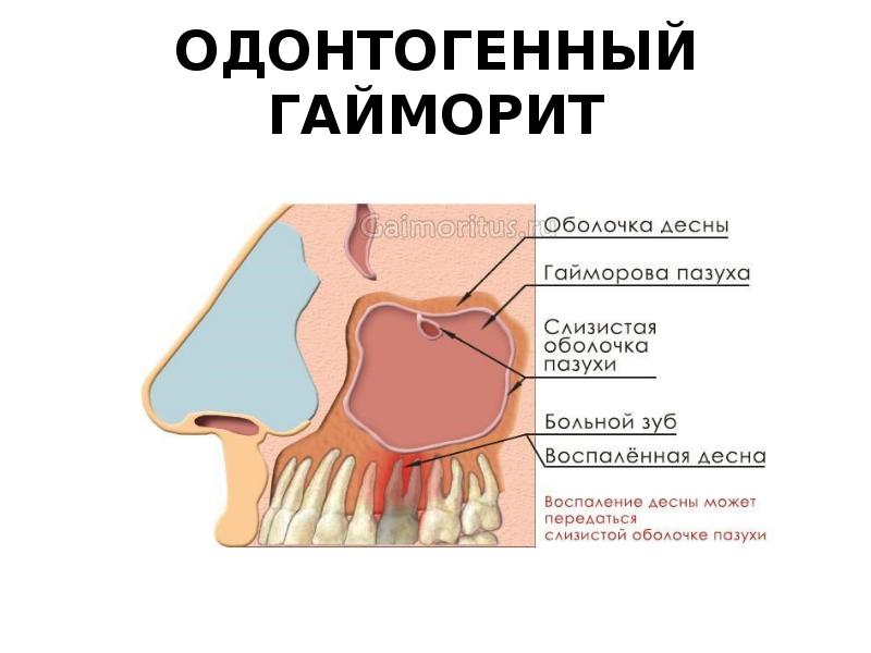 Одонтогенный верхнечелюстной синусит презентация