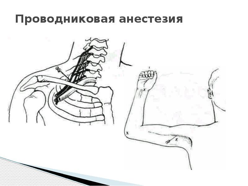 Проводниковая анестезия презентация