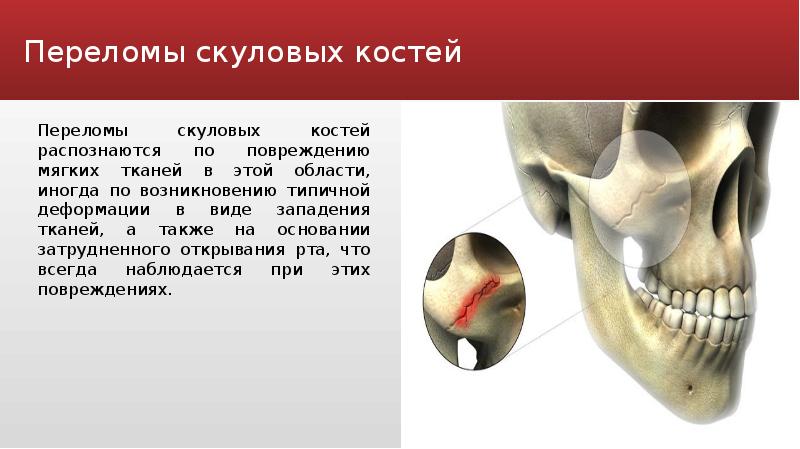 Переломы скуловой кости и дуги презентация