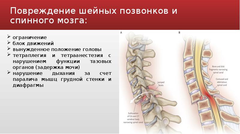 Травма шейного позвоночника