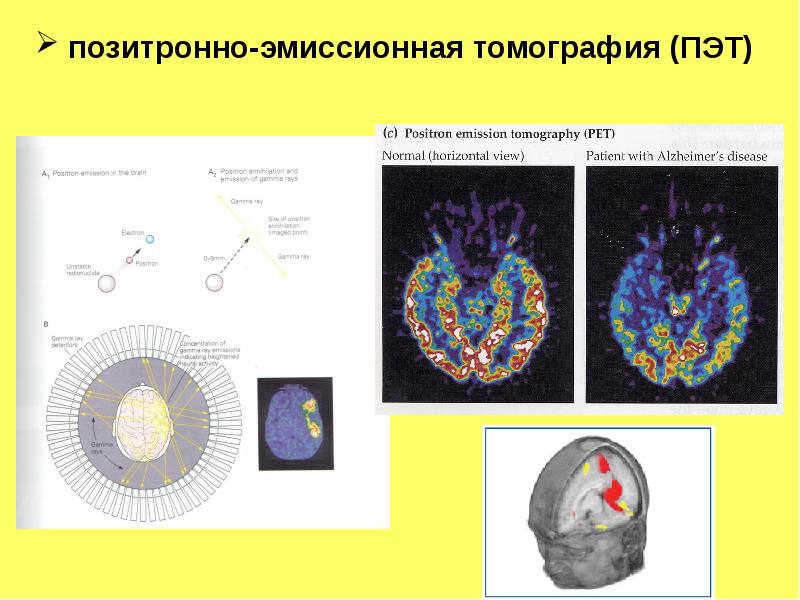 Позитронная томография. Позитронно-эмиссионная томография схема. При позитронно-эмиссионной томографии регистрируется излучение. Позитронно-эмиссионная томография мозга психофизиология. ПЭТ (позитронная эмиссионная томография): достоинства, недостатки..