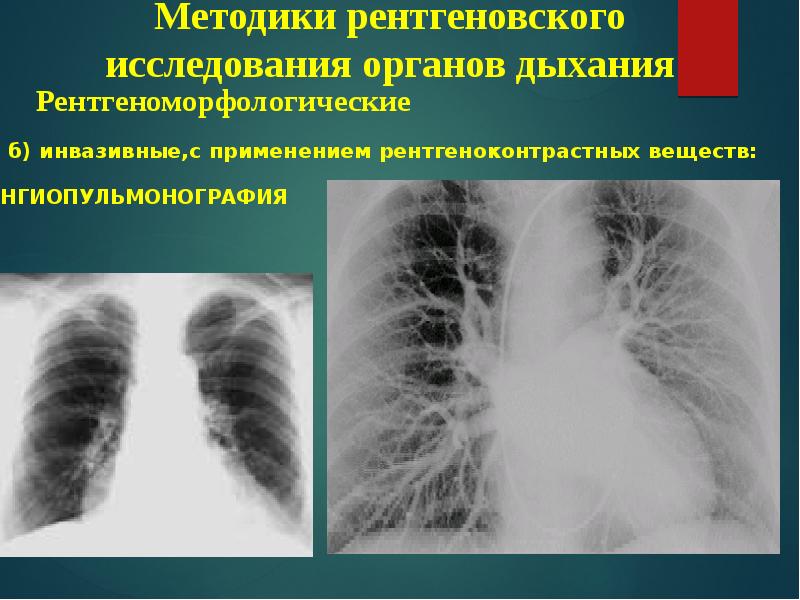 Лучевая диагностика органов дыхания презентация