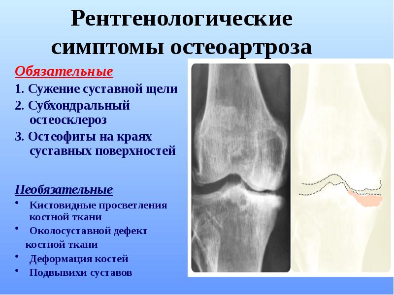 Остеоартрит қазақша презентация