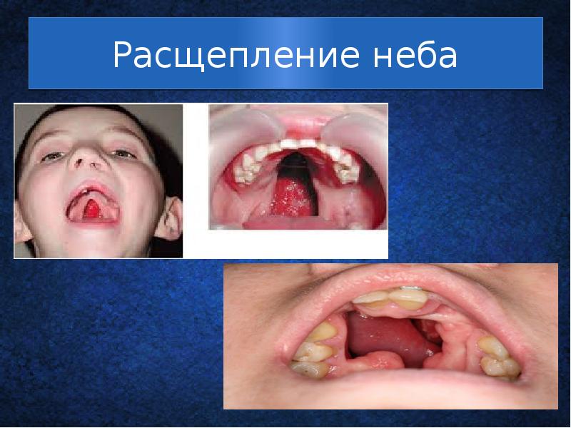 Расщепление неба