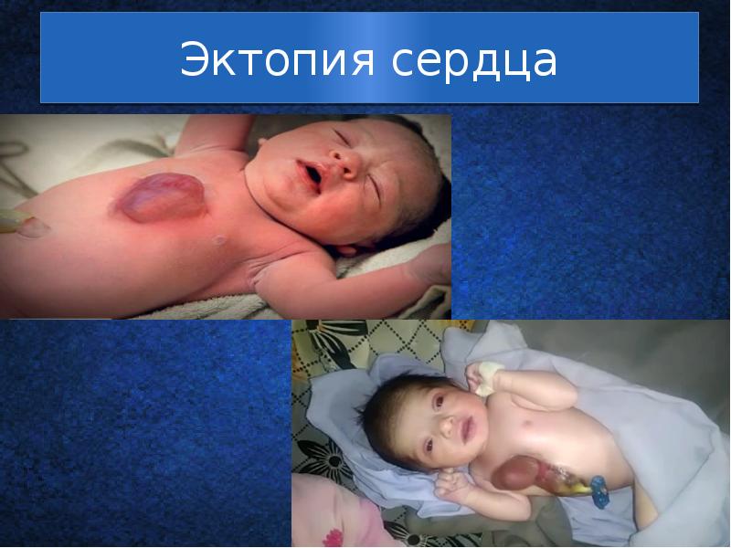 Эктопия сердца