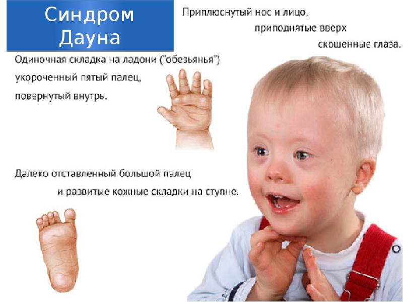 Синдром Дауна