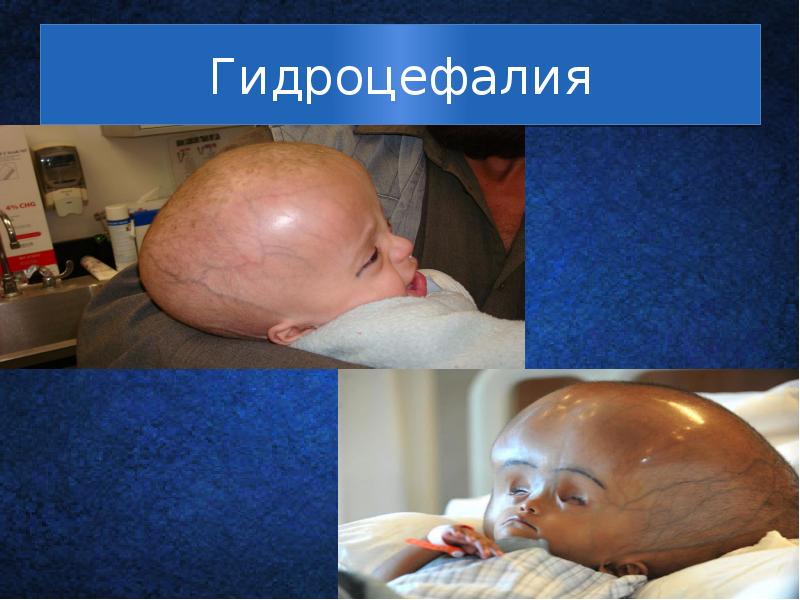 Гидроцефалия