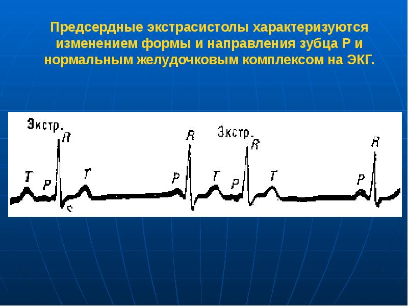 Предсердная экстрасистолия. Политопные предсердные экстрасистолы на ЭКГ. Групповая предсердная экстрасистолия на ЭКГ. Политопная предсердная экстрасистолия на ЭКГ. Предсердная и желудочковая экстрасистолия.