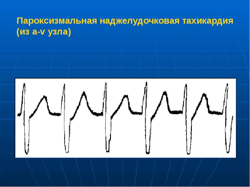 Пароксизмальная наджелудочковая тахикардия. Наджелудочковая тахикарди. Пароксизмальные наджелудочковые тахикардии. Пароксизмальная форма наджелудочковой тахикардии.