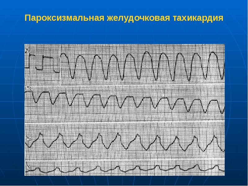 Пароксизмальная тахикардия презентация