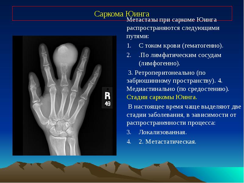 Опухоли костей презентация