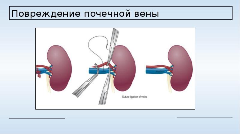 Травмы почек презентация